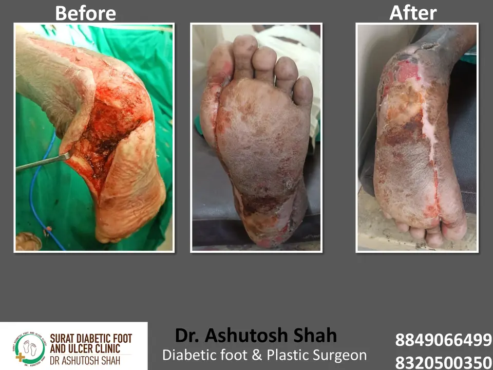 Diabetic Foot  PPT sunita.pptx-9.webp